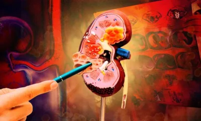 Gagal Ginjal Akut. Ist